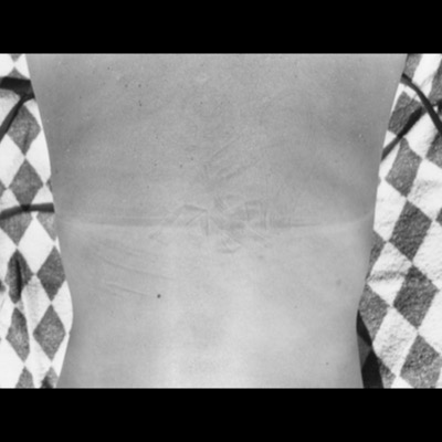 Black-and-white close-up photograph of a sunburned torso with a faint tan line, framed on either side by a checkered blanket.